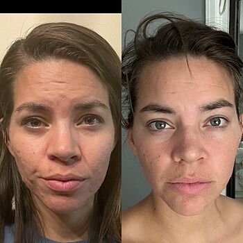 Cleansing Oil (Oily + Acne Prone Skin) Game changer
