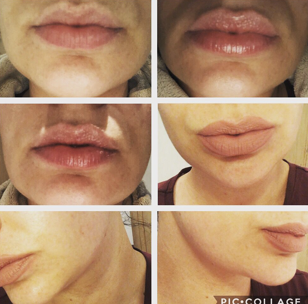 ANGELLIFT® VERMILION VITAL KIT AngelLift