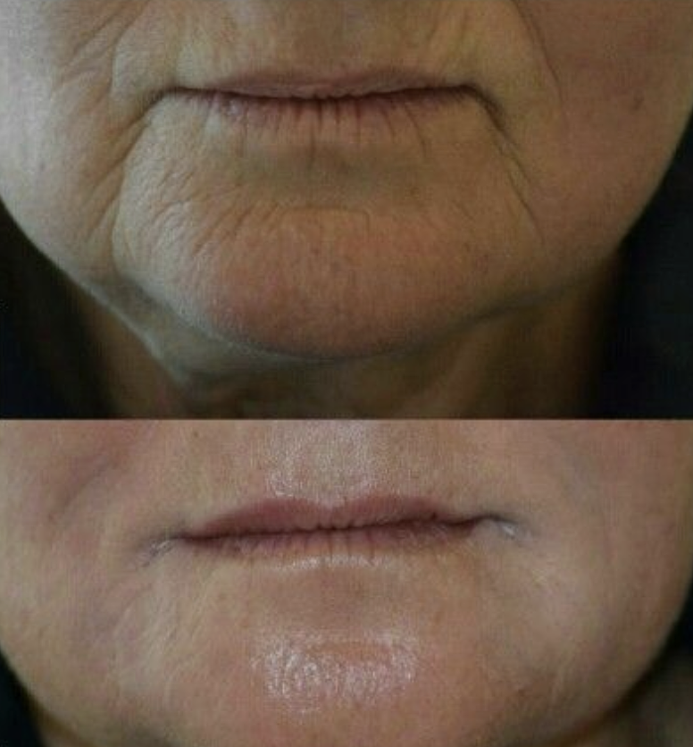 Customer Before Afters Alohalift by AngelLift