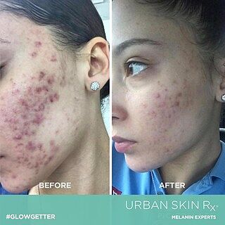 urban skin rx acne